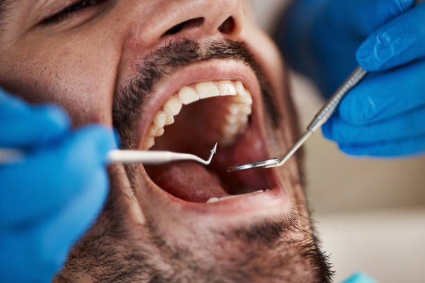 Dental Bonding in Lexington, MI